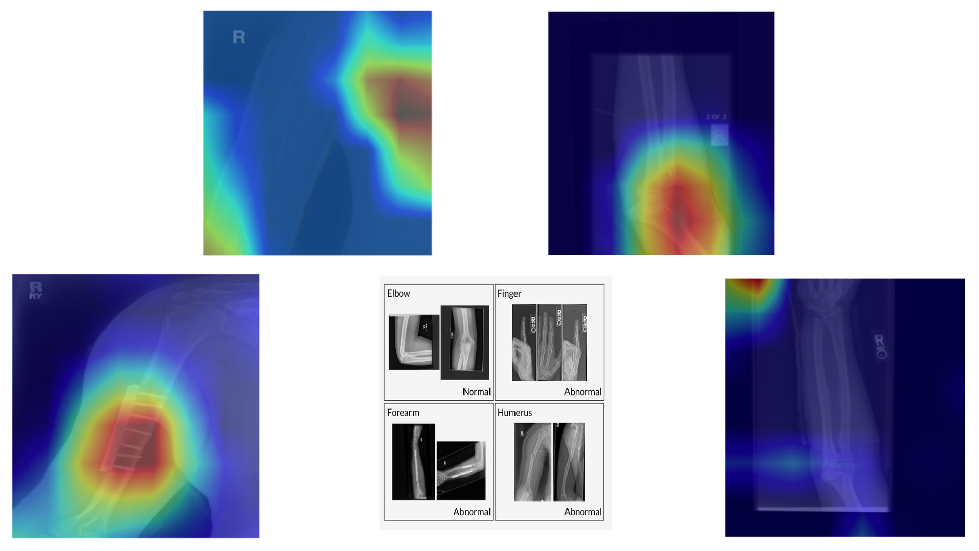 Bone Fracture Classifier